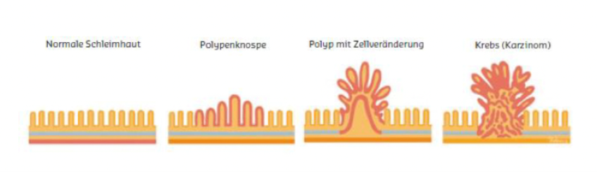 Umwandlung_eines_Polypen_in_Darmschleimhaut_zum_Karzinom